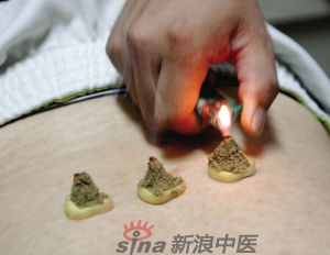 灸法的種類  你知道多少？